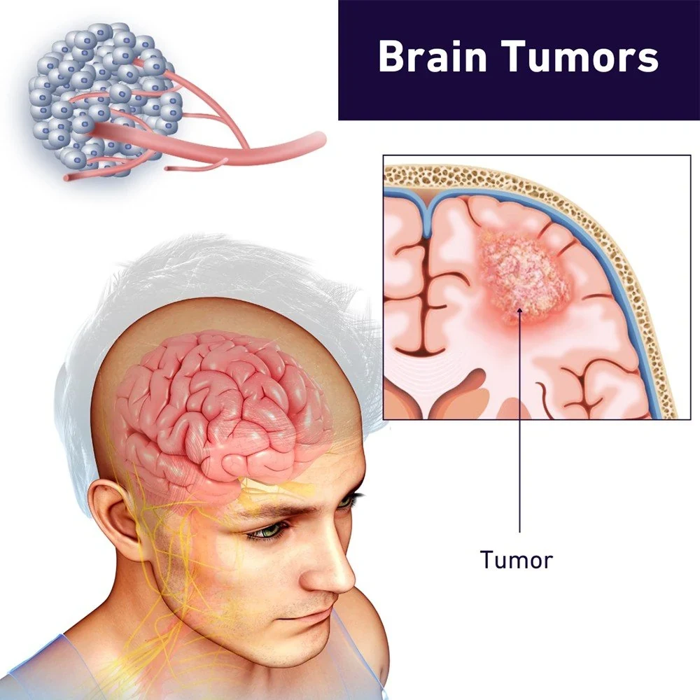 Brain Tumor – Symptoms, Causes, Prevention and Treatment | Sri Vijaya Hitech Hospital