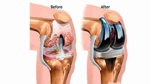 Joint Replacement Surgeons Near Me | Sri Vijaya Hitech Hospital