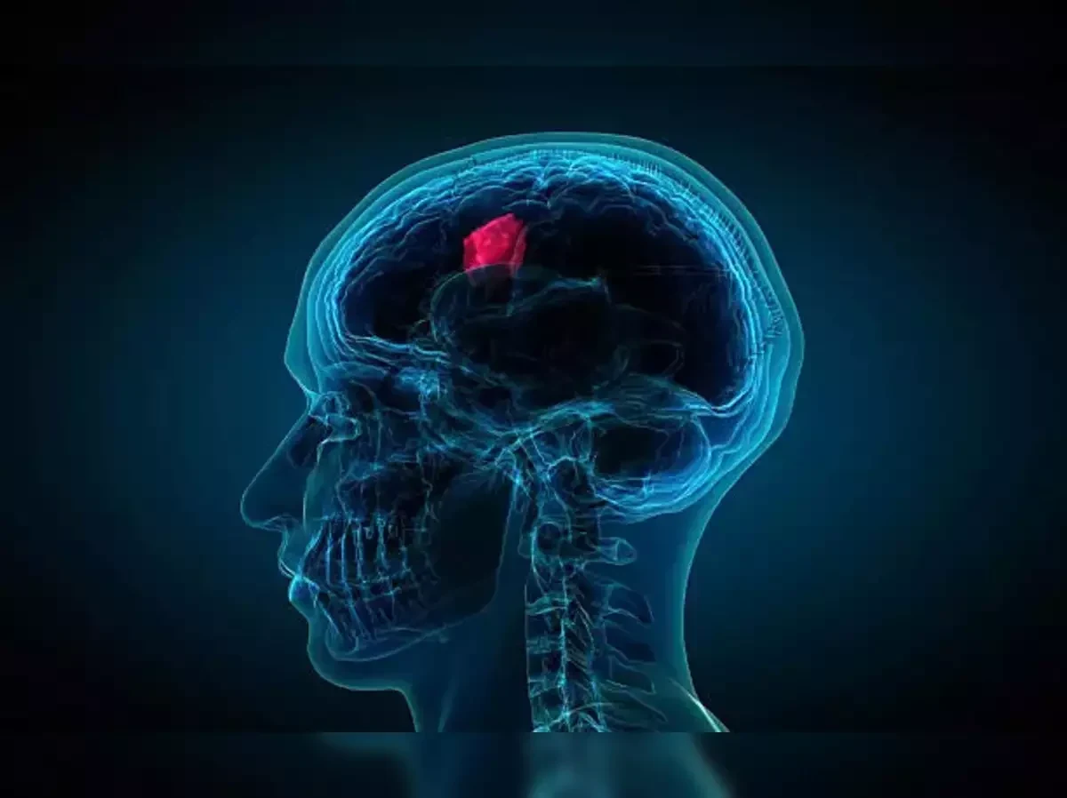 Affordable Brain Tumor Surgery in Erode | Sri Vijaya Hitech Hospital