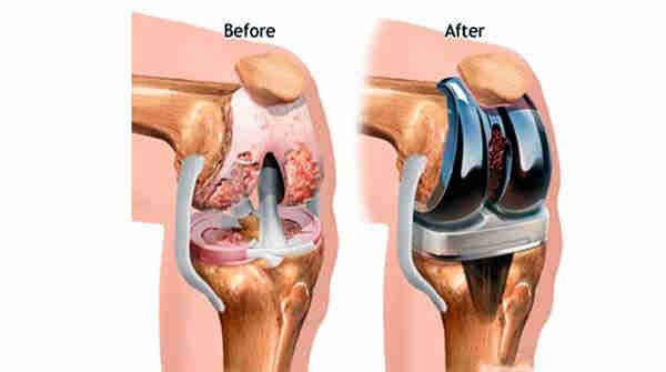 Top Joint Replacement Surgeons in Erode | Quality Care